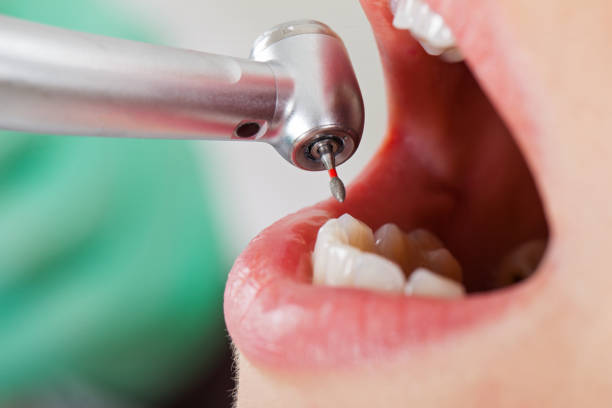 Best Emergency Wisdom Teeth Removal in Haslet, TX